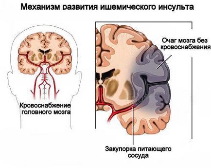 Швидке відновлення після інсульту методами тибетської медицини