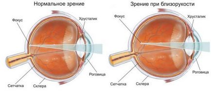 Micopia cum să restabilească vederea, miopia de grad scăzut, de grad mediu, la copii de vârstă școlară,