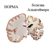 Boala Alzheimer - diagnostic și tratament