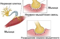 хвороба помпі