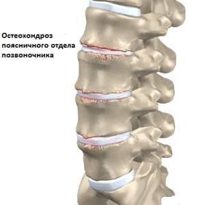 Що робити, якщо болить поясниця і куприк »spine❺