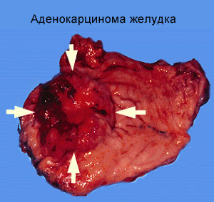 Ce este adenocarcinomul gastric