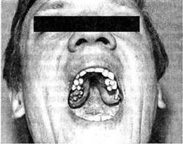 Доброякісні пухлини губ і рота фіброма