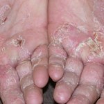 Boala eczemelor, eczemă