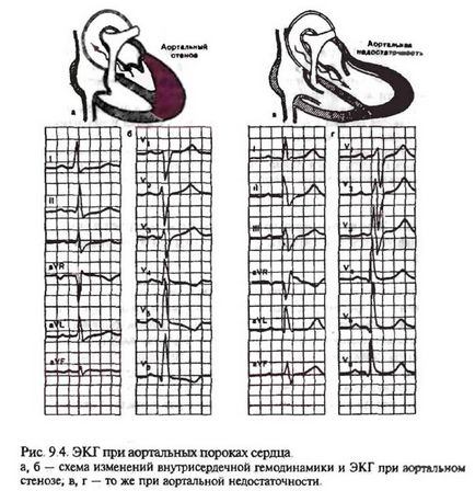 Electrocardiograma cu eșec al valvei aortice (insuficiență aortică)