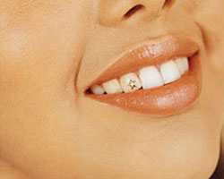 Естетична стоматологія діаманти на ваших зубах
