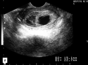 Markeri echografici ai avortului spontan în primul trimestru - pomortsev a