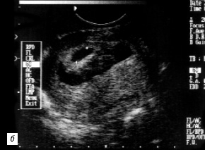 Markeri echografici ai avortului spontan în primul trimestru - pomortsev a