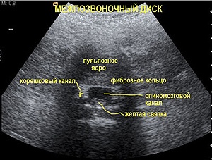 Echospondilografia (uzi)