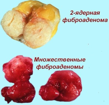 Fibroadenomul sânului, cum se tratează dacă doare