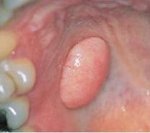 Фіброма порожнини рота - причини, симптоми, діагностика та лікування
