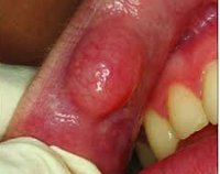 Fibromul gurii - cauze, simptome, diagnostic și tratament
