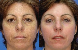 Fotorejuvenarea fotografiei de piele a feței, prețurile, cât de multe proceduri trebuie făcute, contraindicații