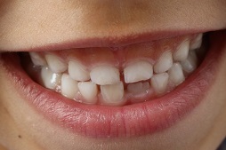 Ínygyulladás gyermekek felismerni és kezelni (gingivitis) Az ínygyulladás a gyermekek felismerni és kezelni