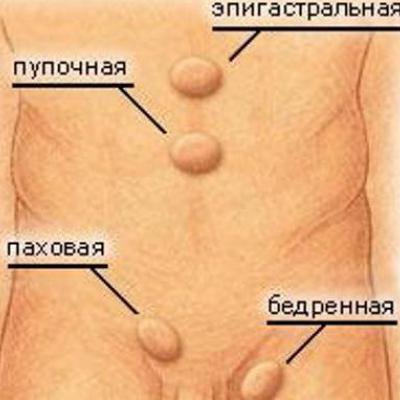 Herniile (hernie inghinală, ombilicală, femurală, postoperatorie a deschiderii esofagiene a diafragmei)