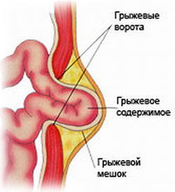 Herniile (hernie inghinală, ombilicală, femurală, postoperatorie a deschiderii esofagiene a diafragmei)