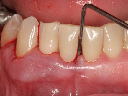 Beültetés periodontitissel és a fogágybetegség lehetséges-e vagy sem