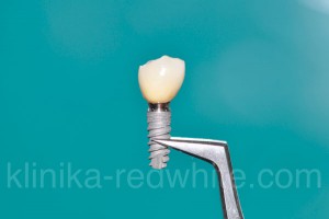 Implantarea în parodonție și boala gingiilor
