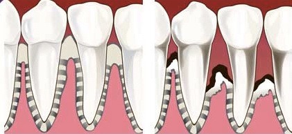 Implantarea în parodonție și boala gingiilor