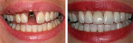 Implantarea dinților - fotografie în etape fără frumusețe