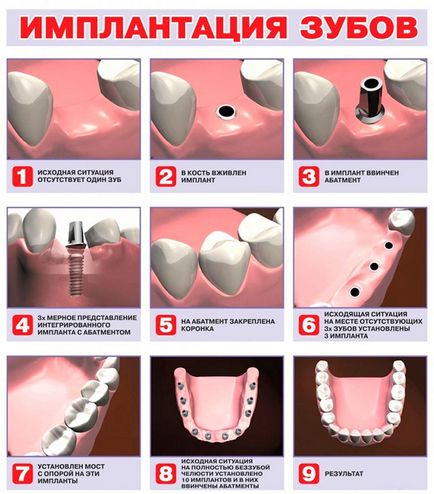 Implantarea dinților - fotografie în etape fără frumusețe