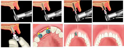 Implantarea dinților - fotografie în etape fără frumusețe