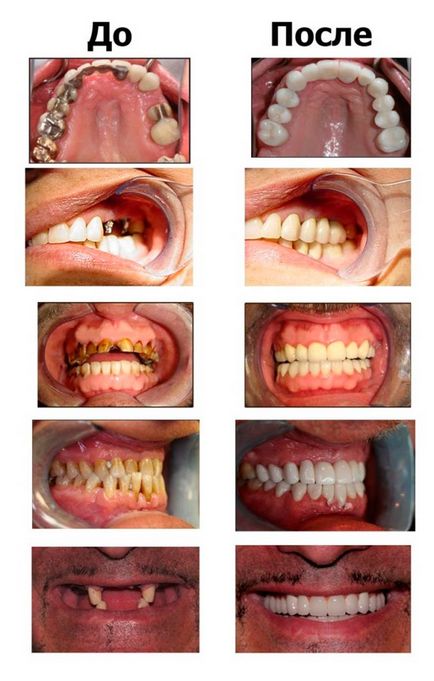 Implantarea dinților - fotografie în etape fără frumusețe