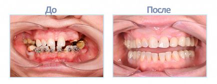 Implantarea dinților - fotografie în etape fără frumusețe