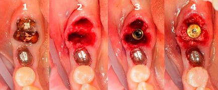 Implantarea dinților - fotografie în etape fără frumusețe