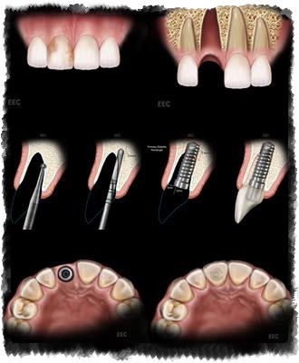 Імплантація зубів фото поетапно, все про зуби