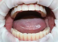 Implantarea dinților cu boală parodontală