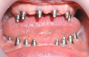 Імплантація зубів при пародонтозі