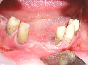 Імплантація зубів при пародонтозі