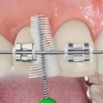Як чистити зуби при лікуванні брекетами поради, питання та відповіді
