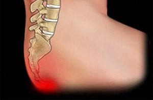 Ce cauzeaza dureri in partea inferioara a spatelui si coccyx