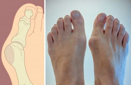 Hogyan lehet megszabadulni a csont a kisujj gyalog haza - kezelésére csont a kis lábujj