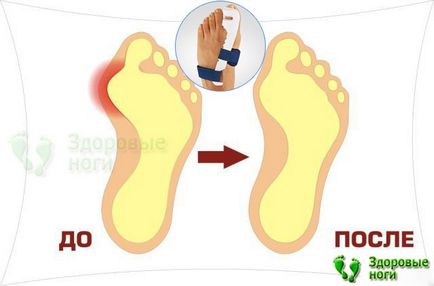 Cum sa scapi de piatra de pe degetul mic al picioarelor acasa - tratamentul pietrei de pe degetul mic al piciorului