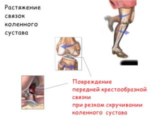 Як полегшити біль в колінному суглобі при розтягуванні зв'язок