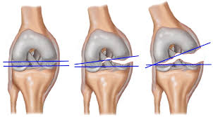 Як полегшити біль в колінному суглобі при розтягуванні зв'язок