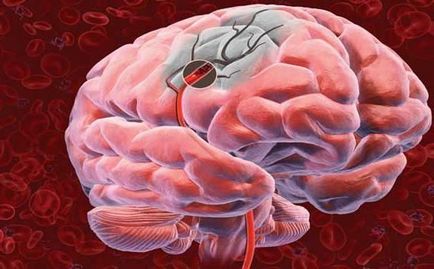 Cum să identificați o tulburare a simptomelor circulației cerebrale, tratamentul