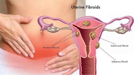 Cum să oprească creșterea fibromului uterin, dimensiuni mari