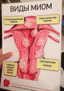 Cum să oprească creșterea fibromului uterin, dimensiuni mari