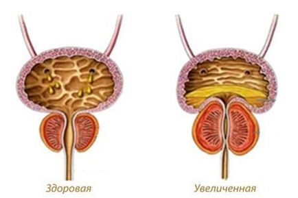 Як проявляється простатит у чоловіків ранні - дзвіночки