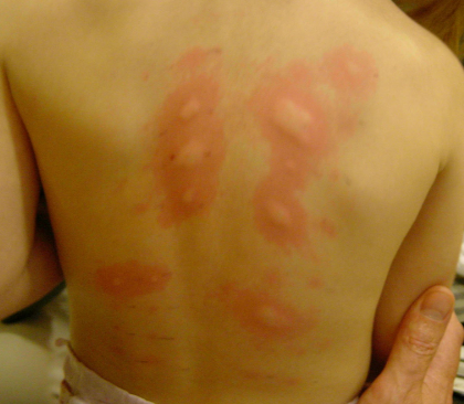 Як виглядає алергія у дитини ліки для лікування