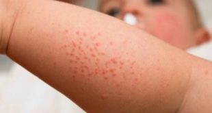 Mi az allergia a gyermek kezelésére szolgáló gyógyszer