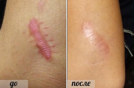 Keloid scars metode moderne de tratament