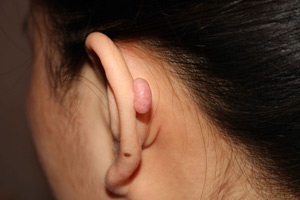 Keloid scars metode moderne de tratament