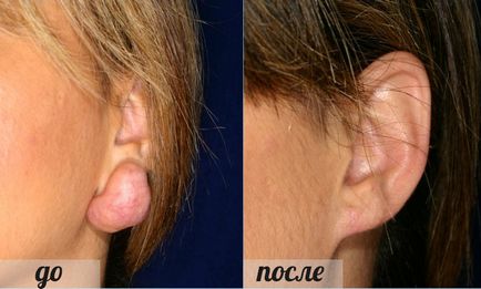 Keloid scars metode moderne de tratament