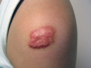 Keloid scars metode moderne de tratament