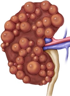 Rinichiul rinichiului la un nou-născut ce să facă când se declară un astfel de diagnostic